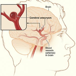 aneurysm cerebral
