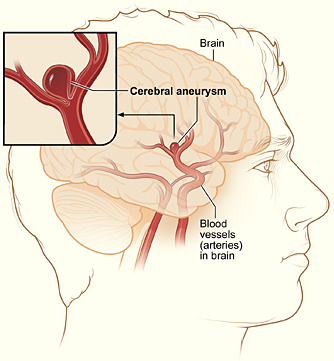 aneurysm cerebral